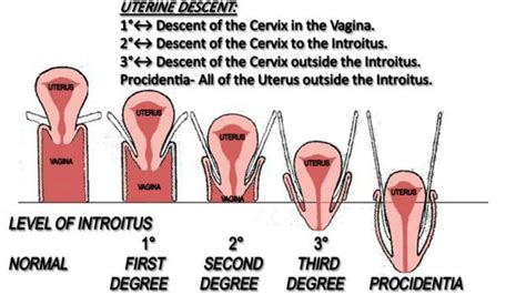 Uterine Prolapse Degree And Staging Youtube