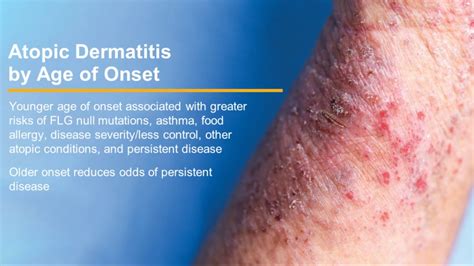 Atopic Dermatitis Strategies To Improve Outcomes Ages 0 2 Mild
