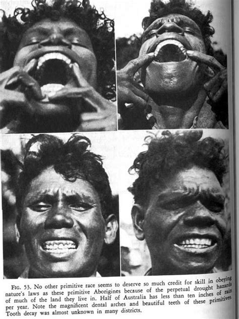 かつてアボリジニに白人社会の食事が与えられたとき歯の状態はこう変わった当時の比較写真 らばQ