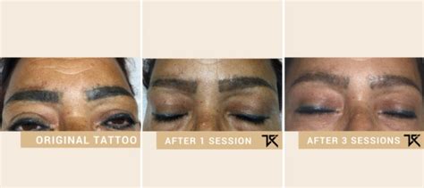 8 Steps To Eyebrow Tattoo Removal Tattoo Removal Institute