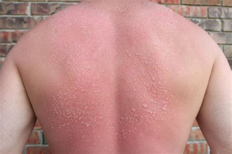 Heat Rash Red Spots With An Itching And Prickling Feeling Could Be