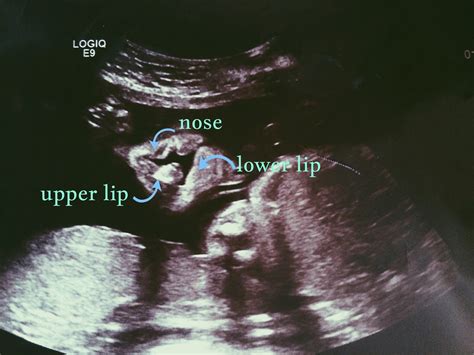 Ultrasound Of Cleft Cleft Lip And Palate Blog Cleft Lip Cleft Lip