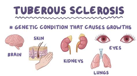 Tuberous Sclerosiswhat To Know