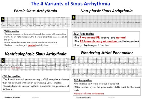 The 4 Variants Of Sinus Arrhythmia Phasic Sinus Arrhythmia Grepmed