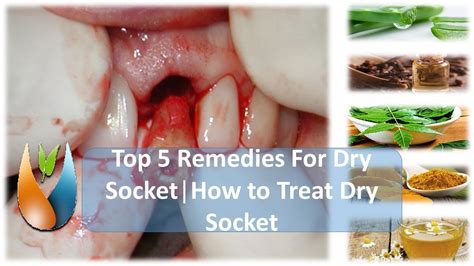 Top 5 Remedies For Dry Socket How To Treat Dry Socket Youtube