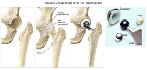 Hip Replacement Fortis Healthcare