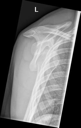 Shoulder Dislocation Radiology Reference Article Radiopaedia Org