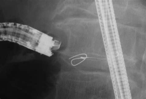 Successful Eus Guided Retrograde Pancreatic Duct Stent Placement For