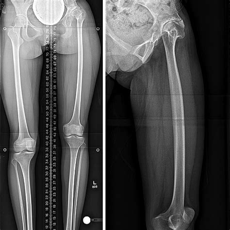 A And B Case 2 Ap And Lateral Radiographs At Initial Presentation