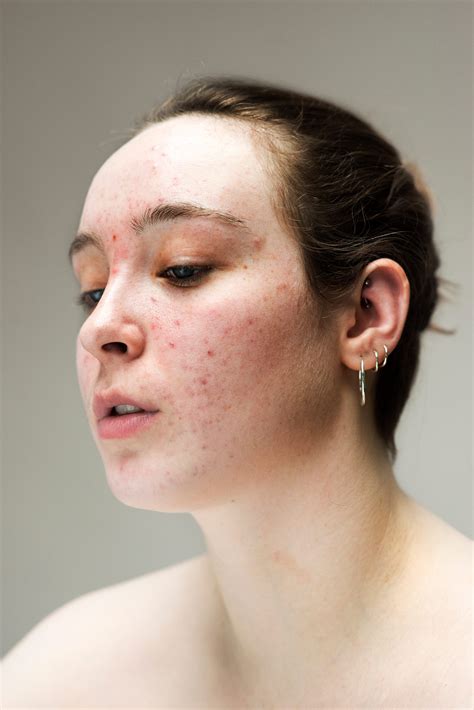 The Raw Beauty Of Women With Acne Eczema And Hyperpigmentation Body