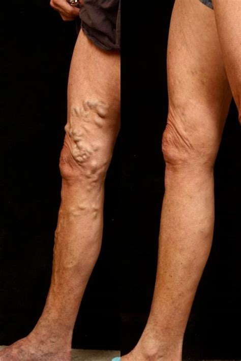 Varicose Veins And Spider Veins Come To The Experts Williamsville