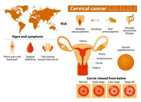 Most Women Miss These Early Signs Of Cervical Cancer David Avocado Wolfe