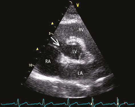 Figure 0312274 Transthoracic Echocardiography Tte Parasternal