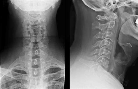 Cervical Spine Radiographs In The Trauma Patient EP Wellness