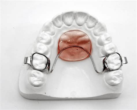 What Is A Nance Appliance In Orthodontics Archwired