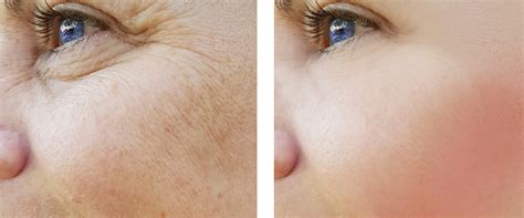 Skin Brightening Lasers Torrey Pines Dermatology La