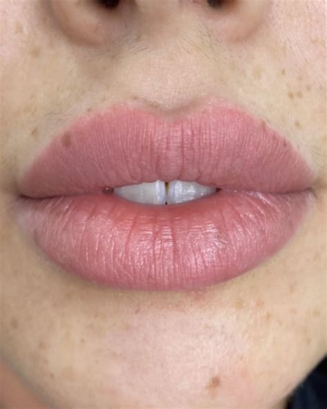 Top Lip Filler Myths Best Clinic Sydney For Dermal Fillers