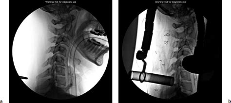 Posterior Cervical Minimally Invasive Microendoscopic Foraminotomy Musculoskeletal Key