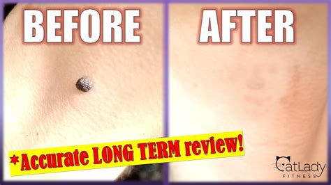 How To Remove A Mole At Home With Apple Cider Vinegar Step By Step