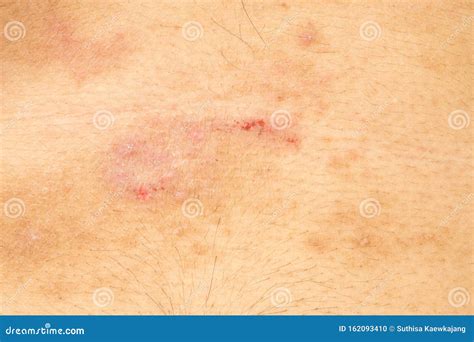 Closeup Image Of A Male Body Suffering From Chronic Skin Rash Food