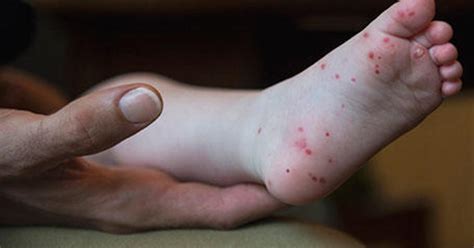 Hand Foot And Mouth Disease Cases Flare Up In Several States Cbs News
