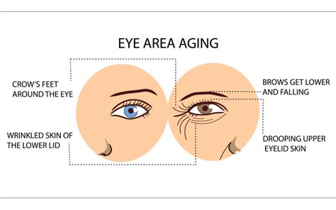 Under Eye Wrinkles Causes Prevention And Treatment Vedix