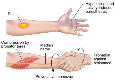 Is There A Light At The End Of The Carpel Tunnel Triada Health Ottawa