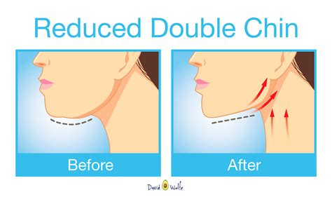 How To Lose Neck And Chin Fat