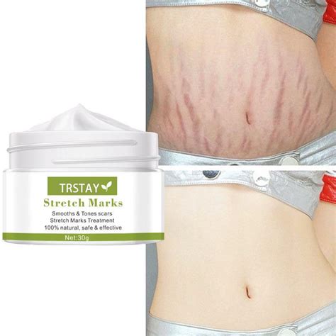 Trstay Stretch Mark Cream Removes Scars And Marks Skin Whitening Cream