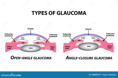 Types Of Glaucoma Open Angle And Angle Closure Glaucoma The