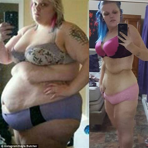Woman Who Lost Lbs Left With Apron Of Excess Skin Daily Mail Online