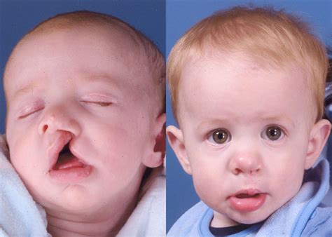 Cleft Jaw Surgery Nyc Cleft Repair James P Bradley Md