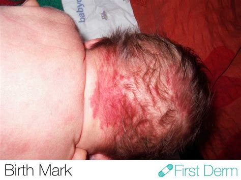 The Top 5 Newborn Skin Conditions