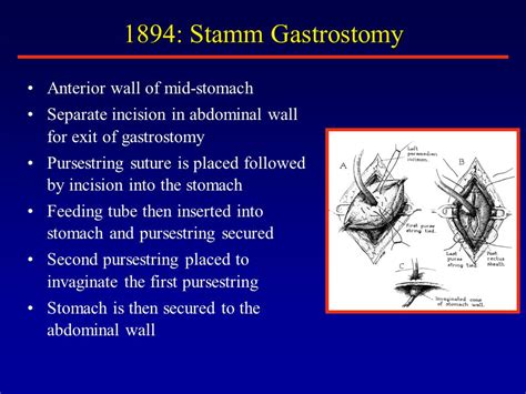 Gastrostomy Past And Present Ppt Video Online Download