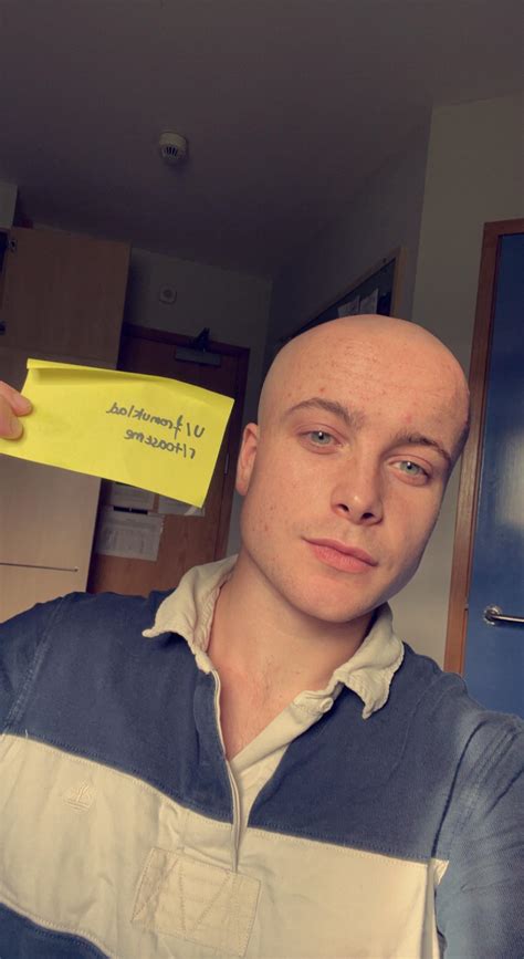 M23 Acne And Baldness Getting Me Down A Little Bit Recently R Toastme