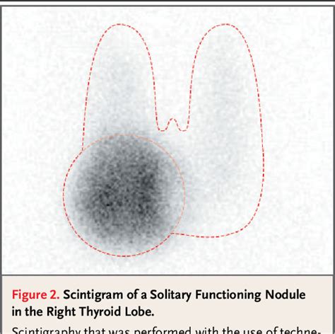 Thyroid Nodule Semantic Scholar