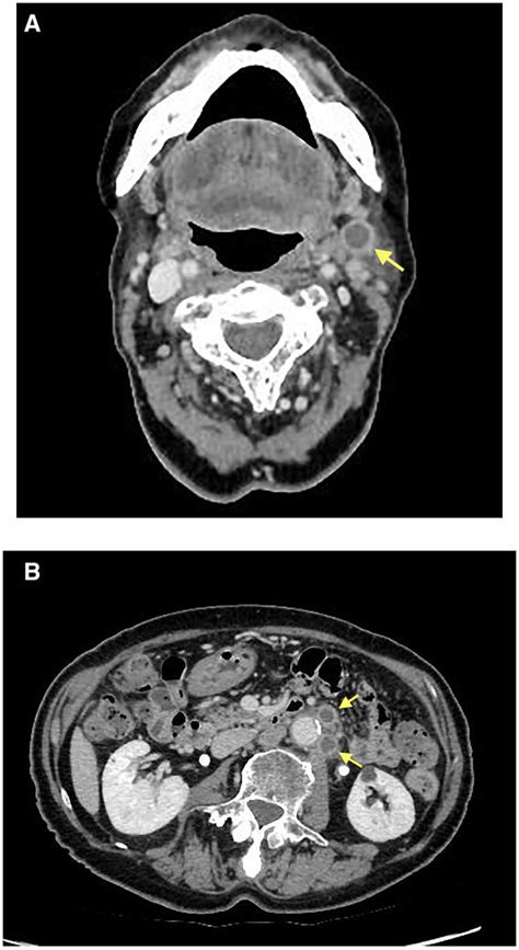 A And B Contrast Enhanced Ct Revealed Generalized Lymphadenopathy