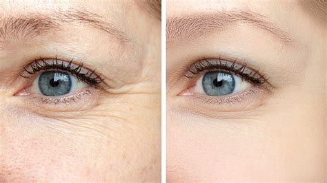 What To Know About Prohilo Treatment For Wrinkles Sl Aesthetic Clinic