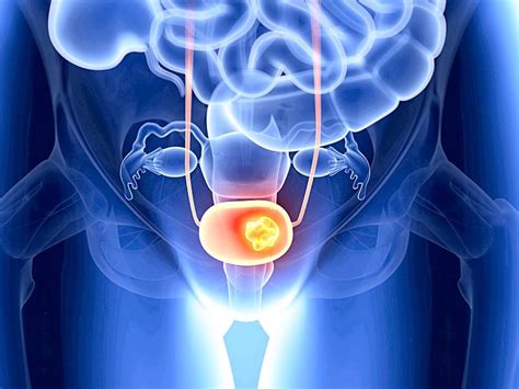 First Study On Bladder Cancers Presenting As Utis