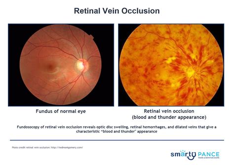 Central Retinal Artery Occlusion Vs Normal