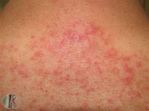How To Identify 4 Common Skin Rashes Alergia Piel Pic