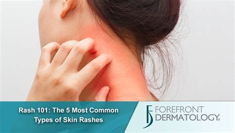 Rash 101 The 5 Most Common Types Of Skin Rashes DermSpecialists