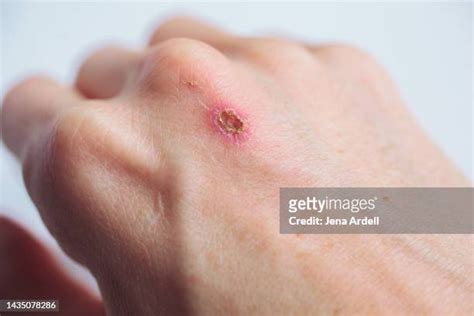 Skin Scab Photos And Premium High Res Pictures Getty Images