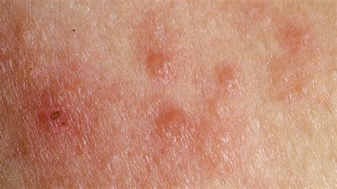 Nueva Hipótesis Sobre Cómo Ciertos Químicos Producen Dermatitis De