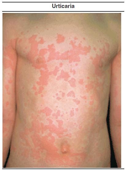 Childhood Rashes That Present To The Ed Part Ii Fungal G Annulare