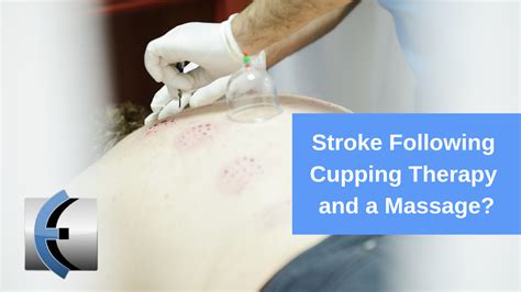 Stroke Following Cupping Therapy And A Massage What Cupping