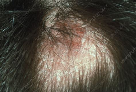 Tinea Capitis Ringworm Of The Scalp Stock Image M2700085 Science