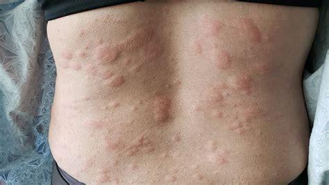 Hives Symptoms How You Know Its Really Hives Everyday Health
