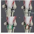 Figure 2 from Tension band suture fixation for olecranon fractures ...