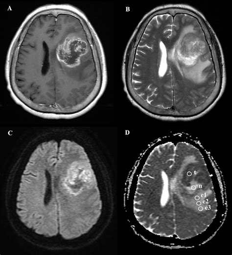 A 64 Year Old Female With Pathologically Proven Glioblastoma Multiforme